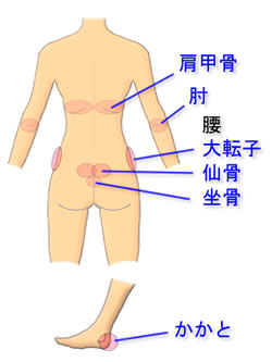 }@ 傭 ̂ł₷ Pressure Ulcers page